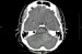 CT mozku 2008-05-06.JPG